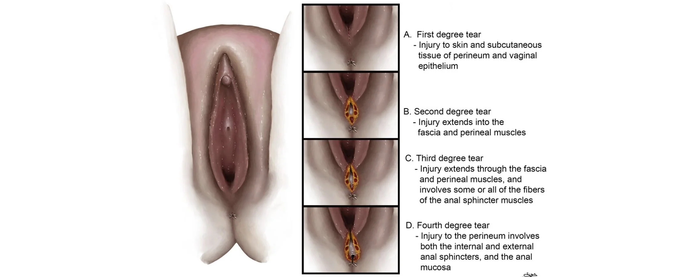 Caring for Tears &amp; Stitches After Birth: Traditional Ways to Support Healing
