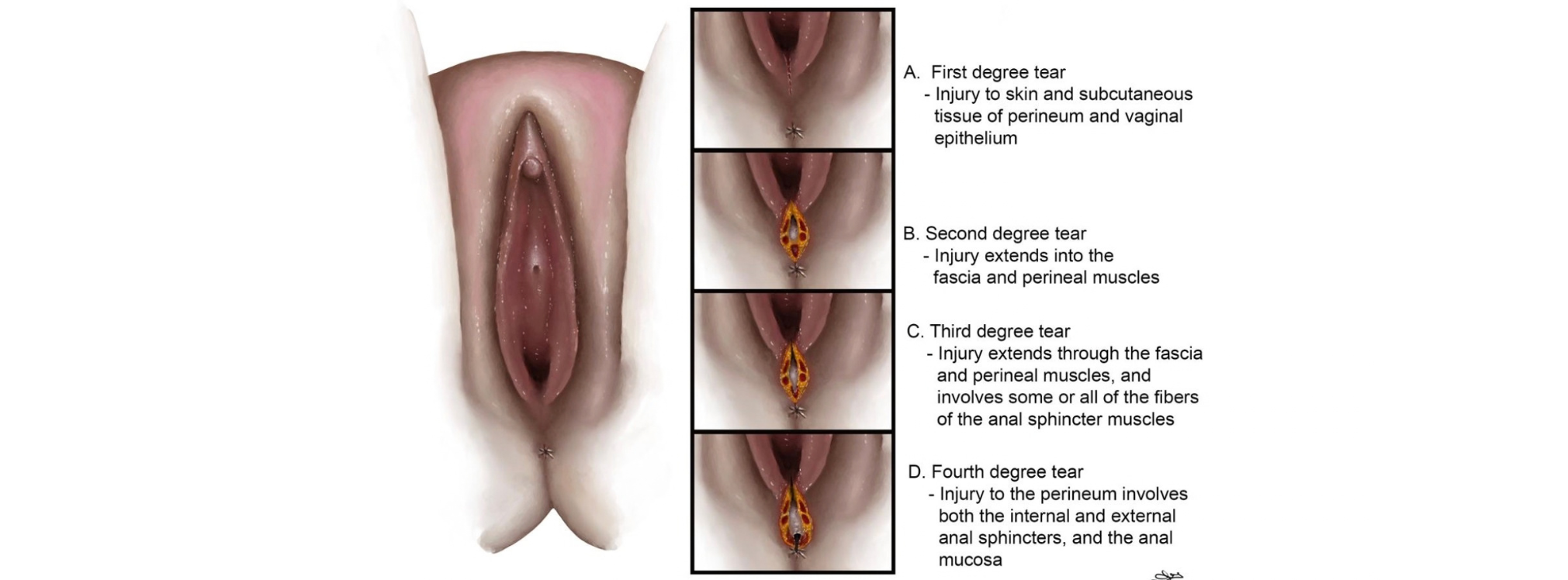 Caring for Tears &amp; Stitches After Birth: Traditional Ways to Support Healing