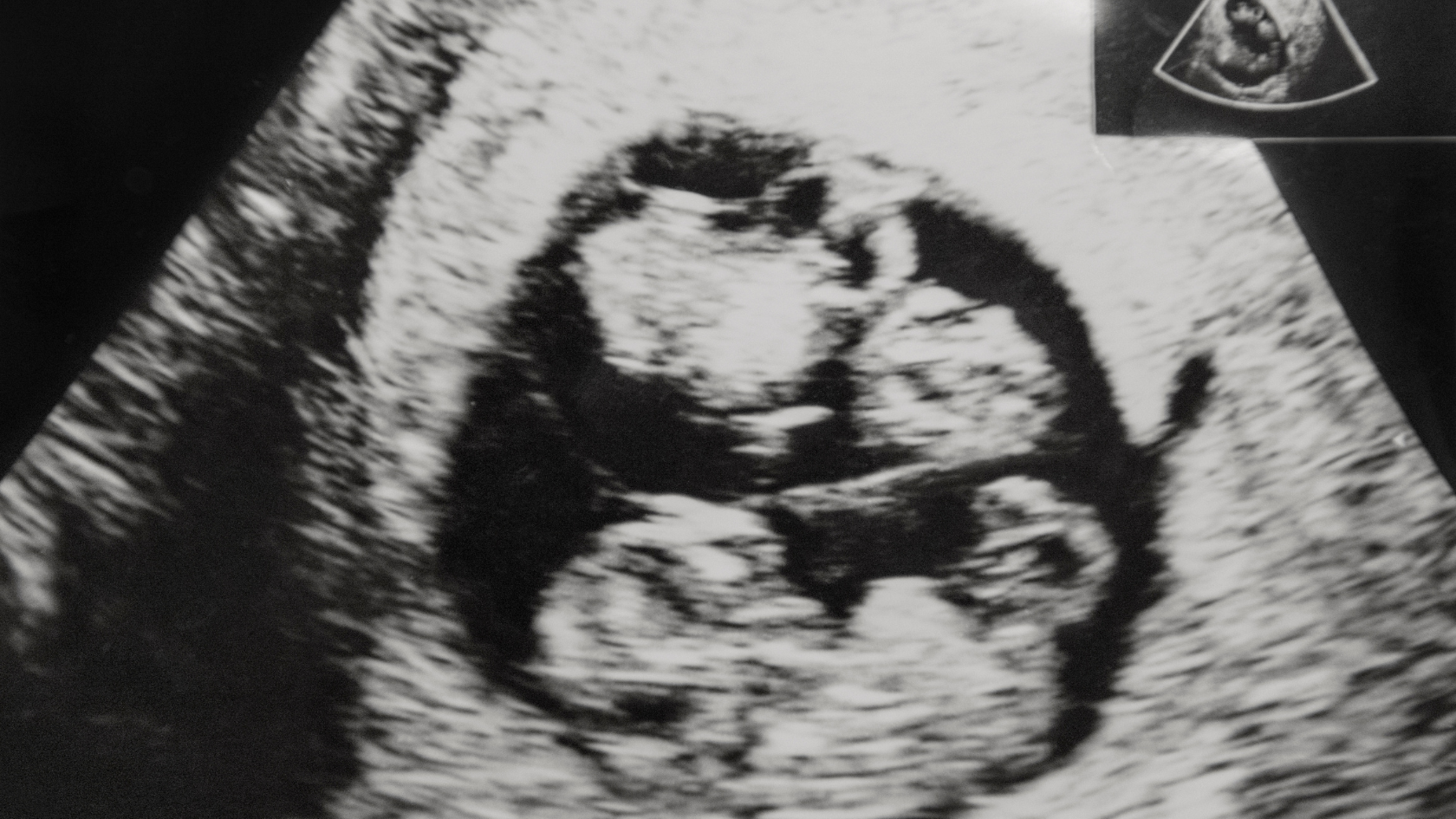 Twin Pregnancy &amp; Birth: Beyond Fear, Guidelines and the ‘Allowing’ of Women’s Bodies
