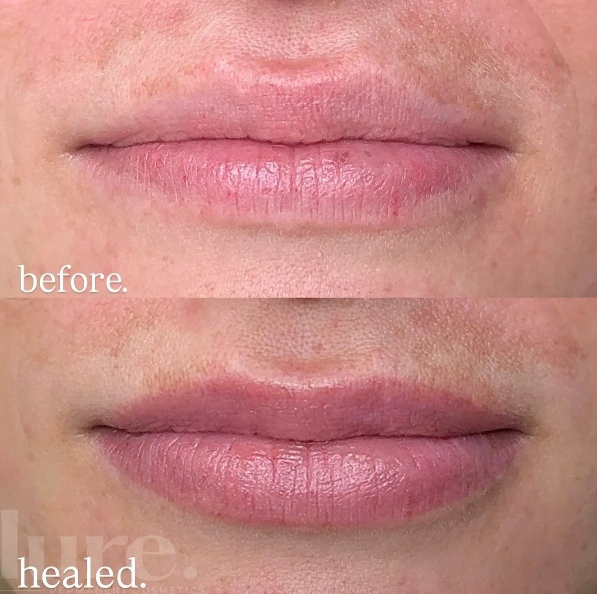 Swipe to see why healed results > fresh results

&ldquo;I absolutely LOVE my lips btw. 💕 Wish I had done this years earlier!&rdquo; 👈 (her words for real)

What you see immediately after is not the final result &mdash; and that&rsquo;s exactly h
