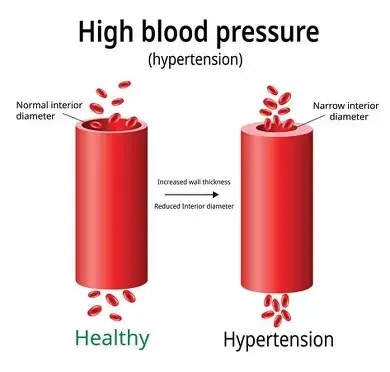 a picture of high blood pressure