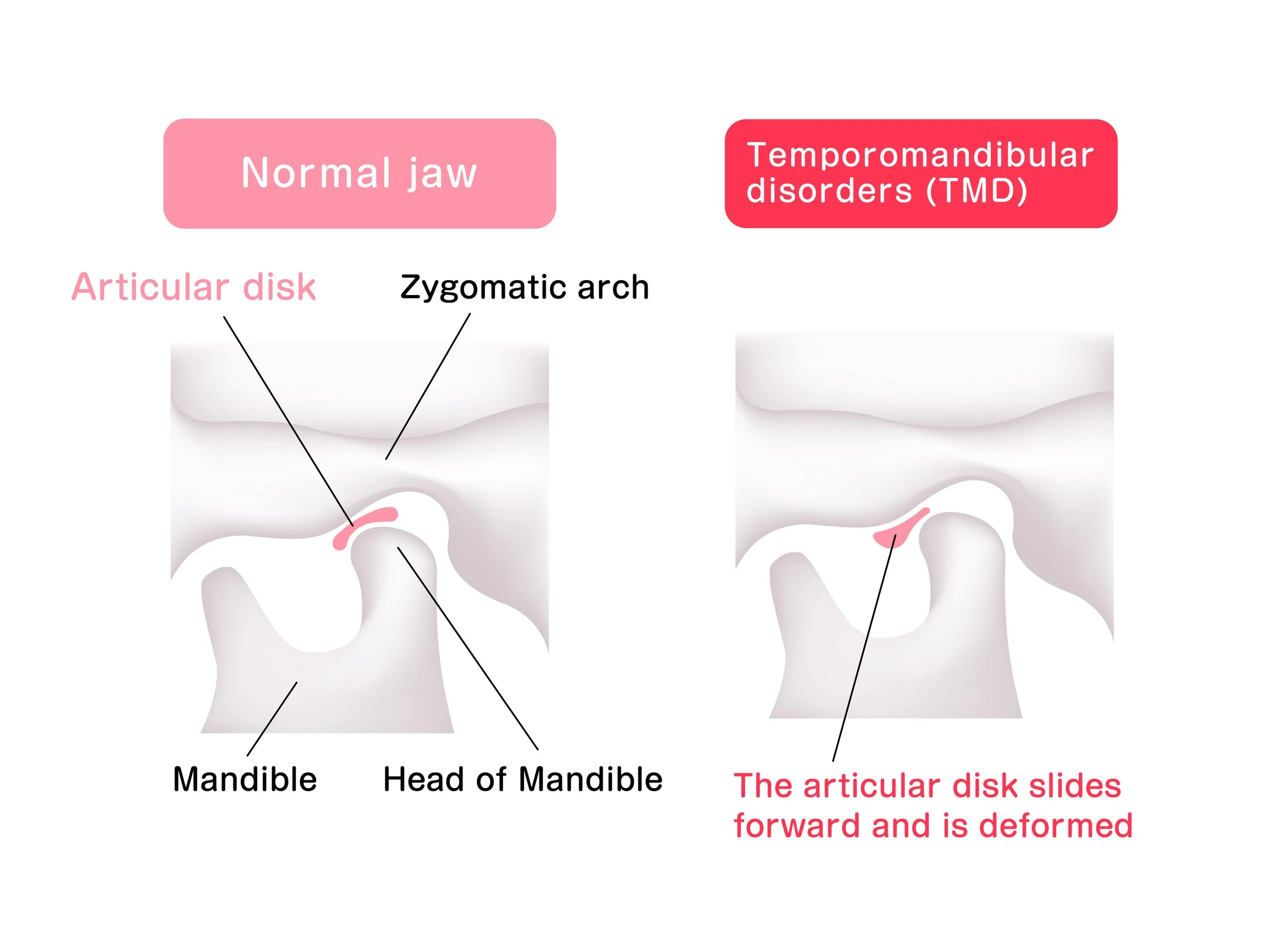 illustration comparing the shapes of the articular disk (normal jaw and temporomandibular disorders)