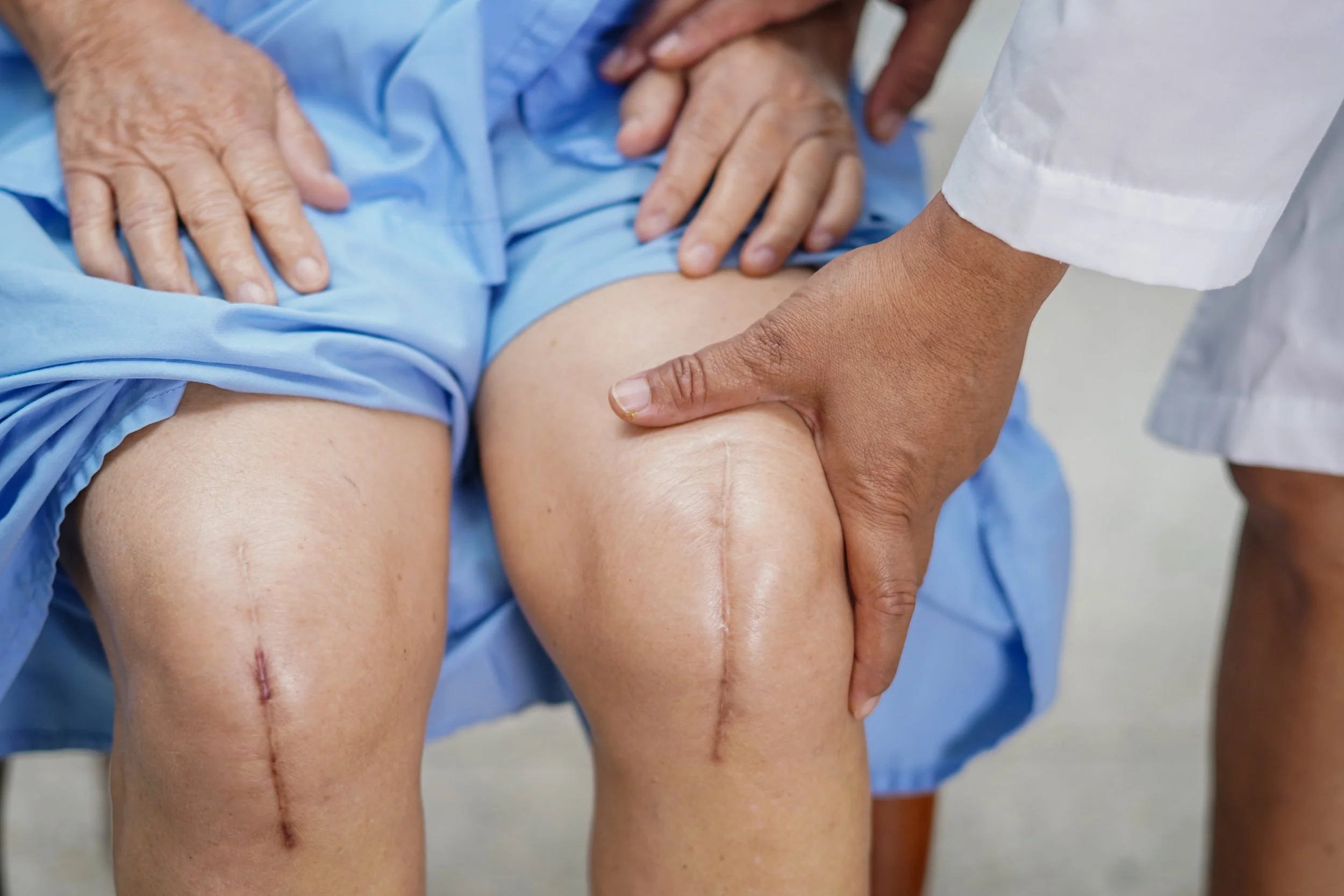elderly woman show her scars surgical total knee joint replacement Suture wound surgery arthroplasty on bed
