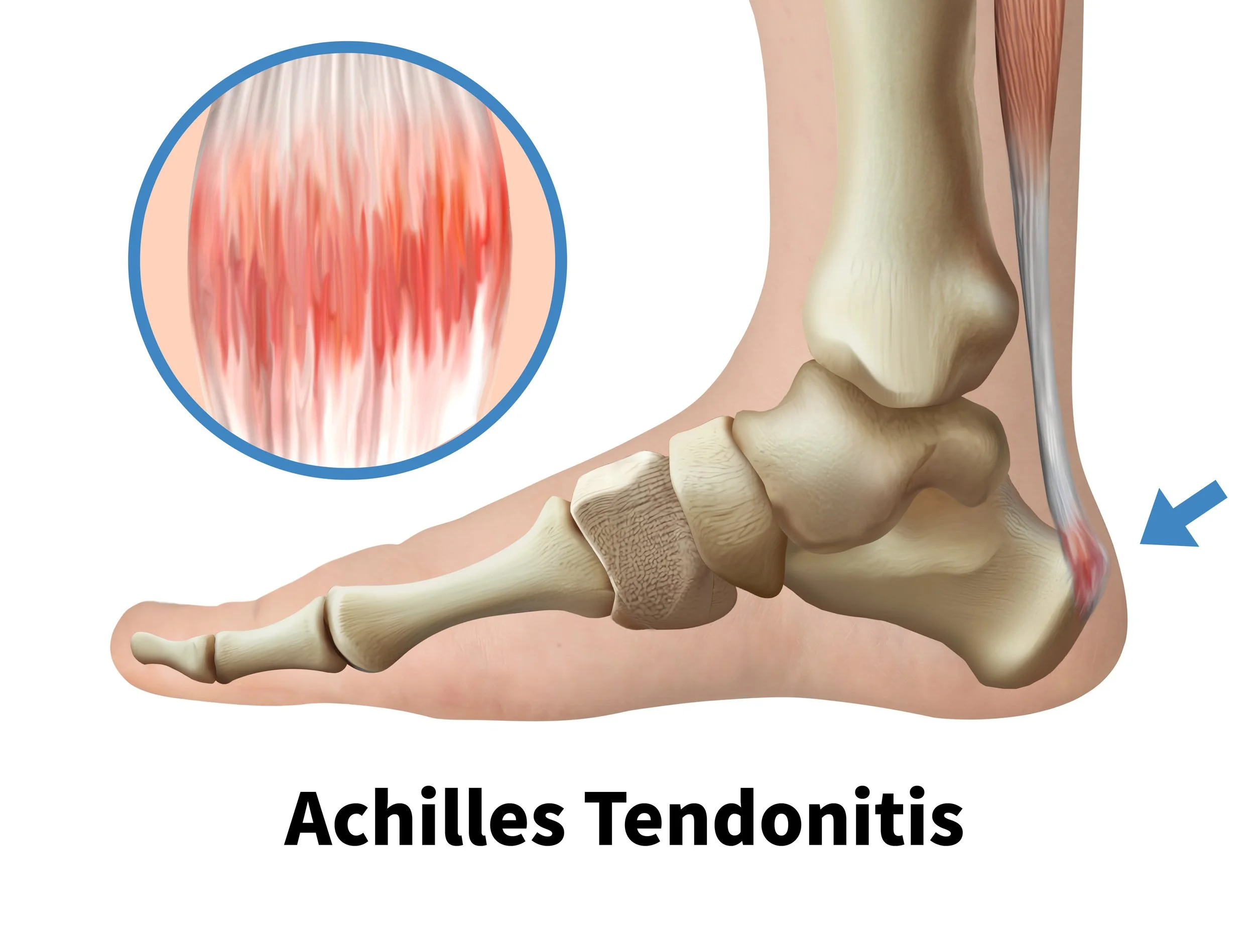 Achilles tendonitis Foot medical illustration