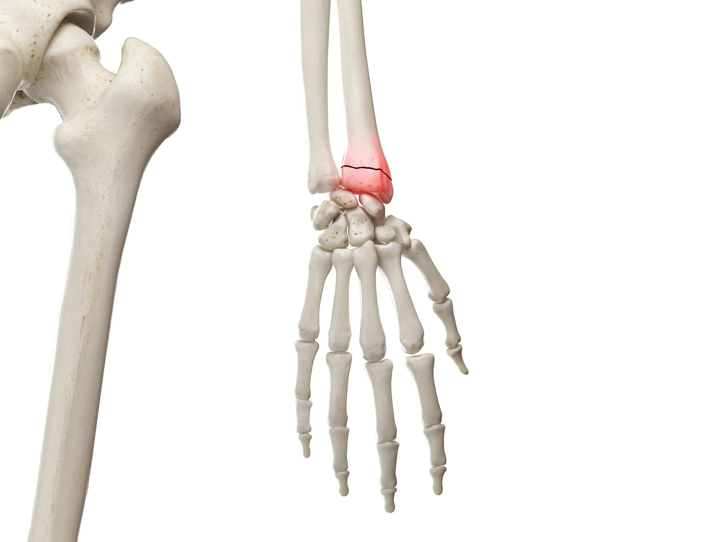 3d rendered medically accurate illustration of a broken wrist fracture