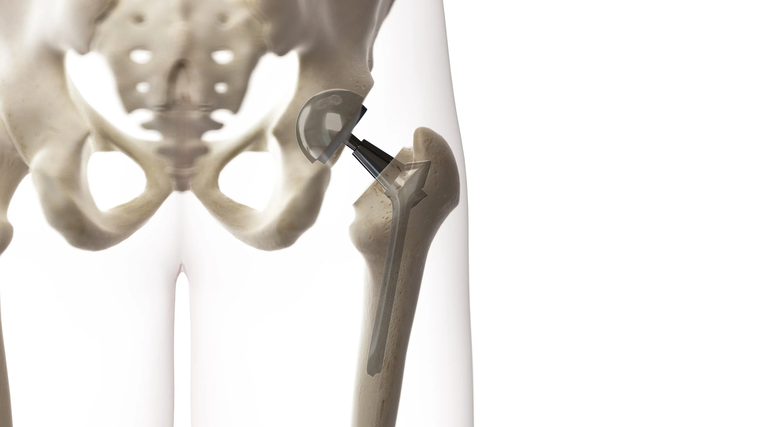 3d rendered medically accurate illustration of a hip replacement