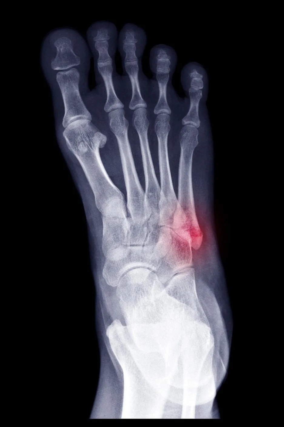 X ray radiograph show toe bone broken (base of metatarsal fracture or Jones fracture). Highlight on fracture site and painful area