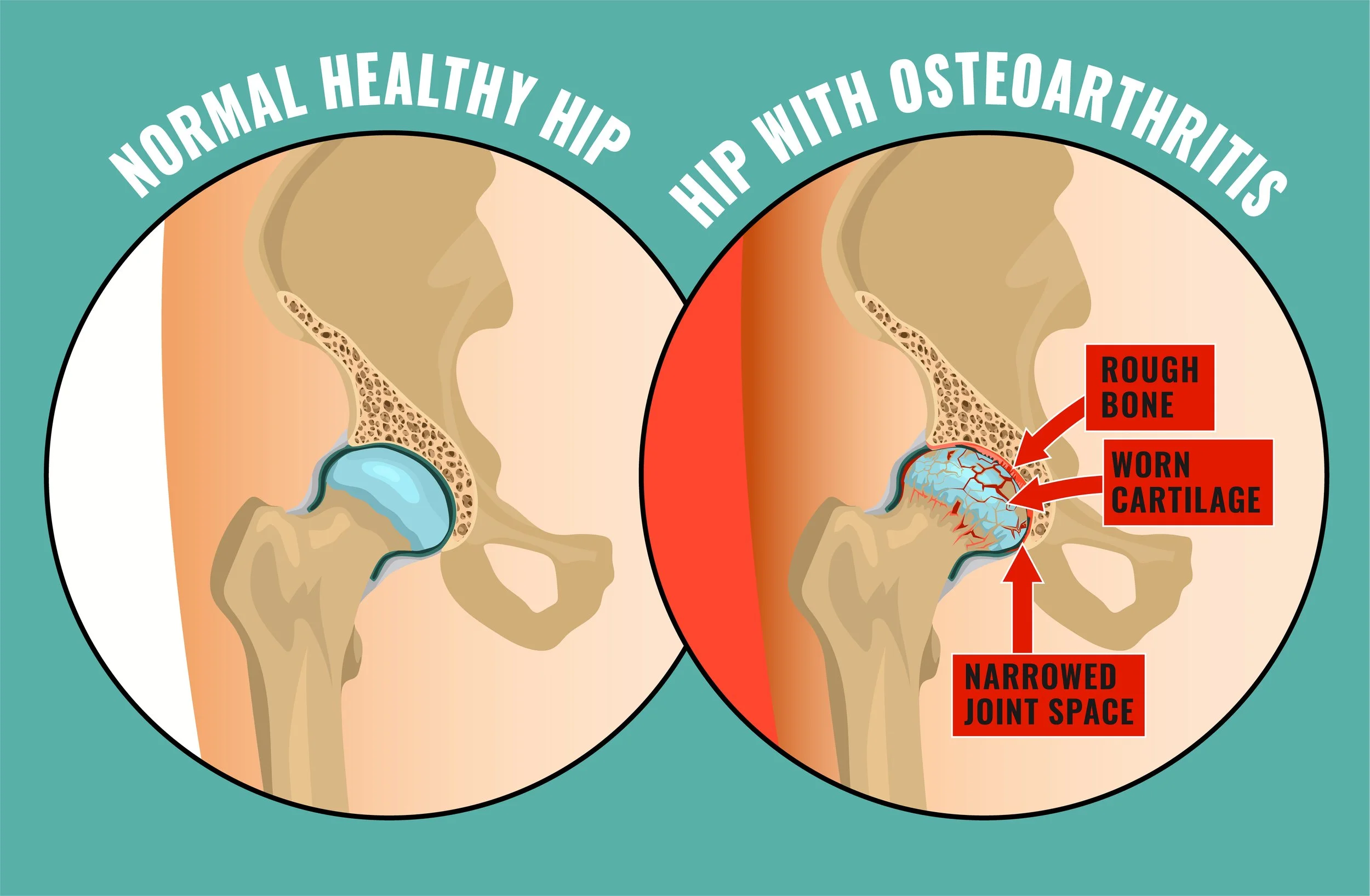 Infographic comparison of normal healthy hip with hip with osteoarthritis