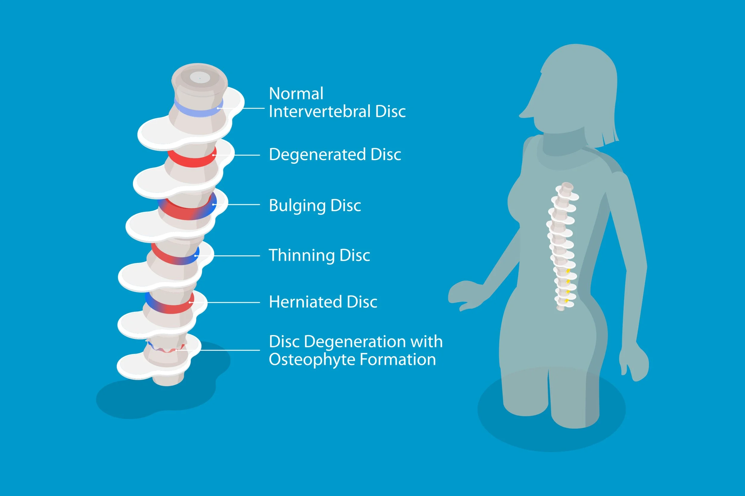 3D Isometric Flat Vector Conceptual Illustration of Degenerative Disc Disease, Educational Medical Schema