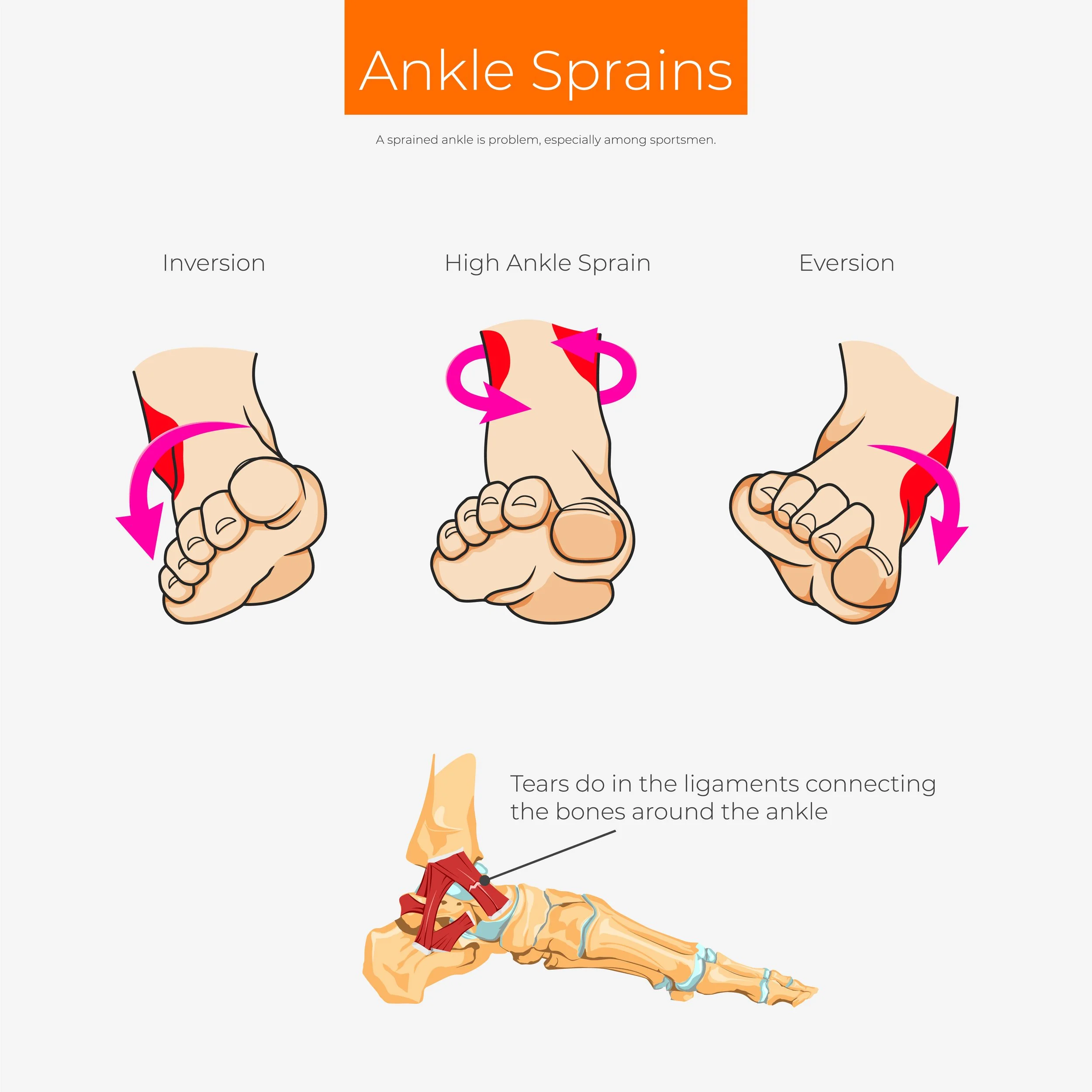 Types of ankle sprain or strain scheme poster