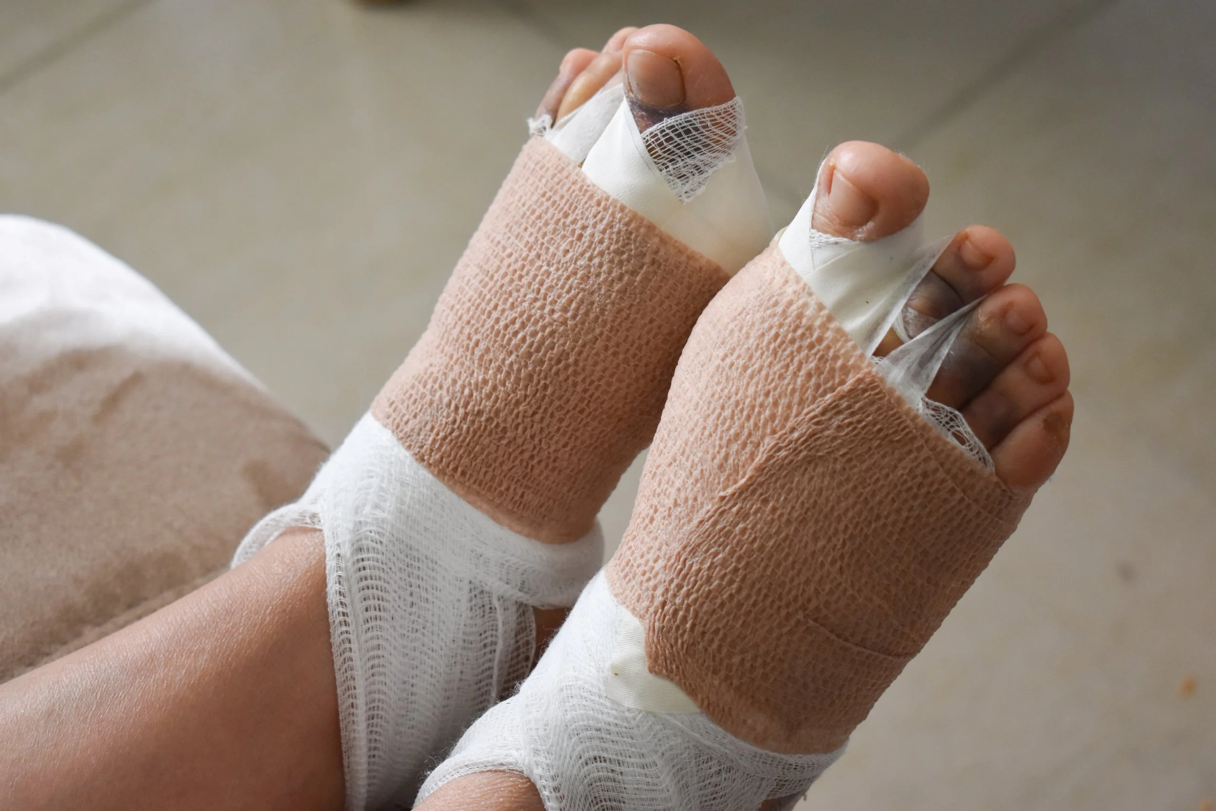Feet bandaged from foot or ankle surgery
