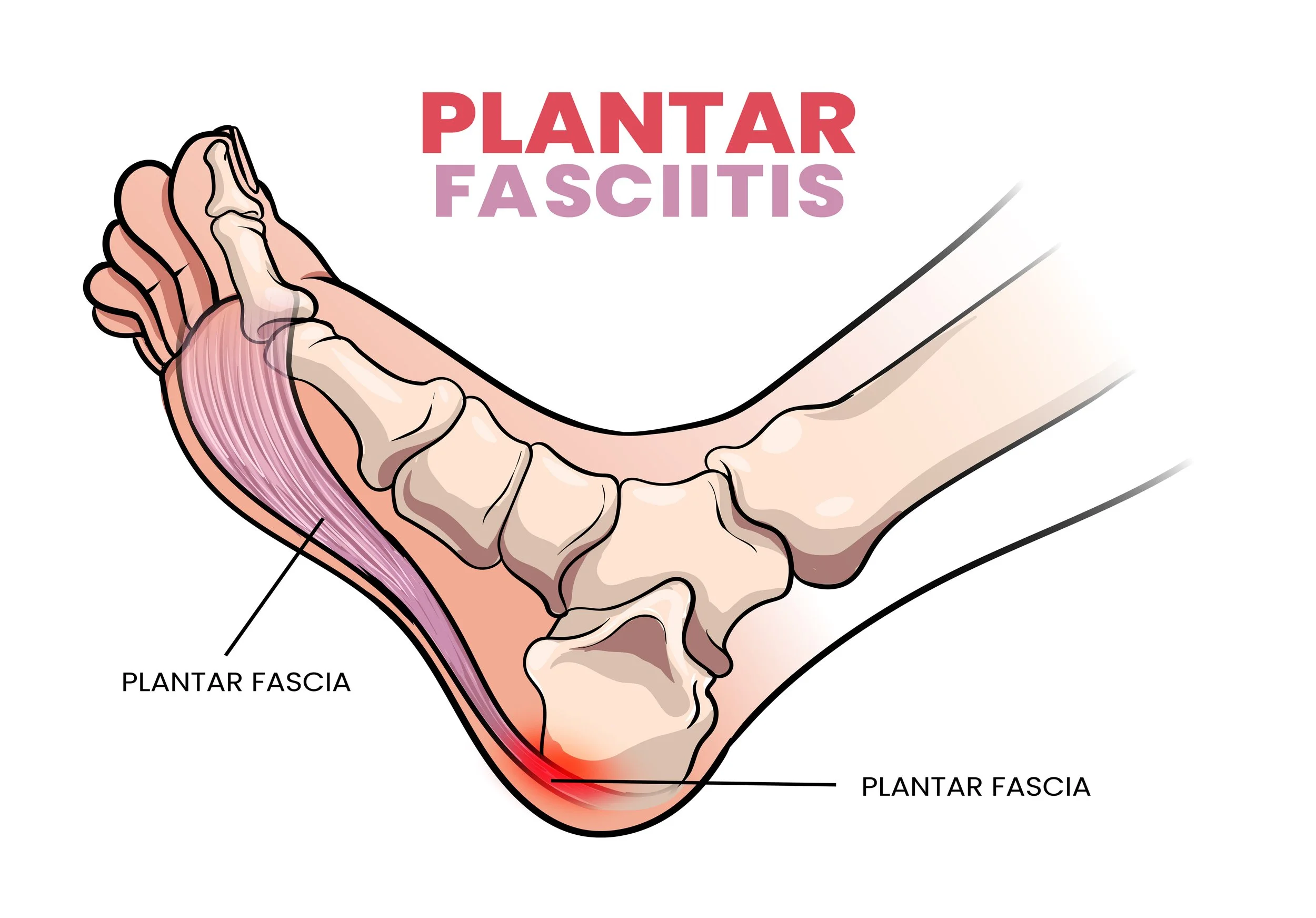 Plantar fasciitis inflammation and ruptures strain. Foot pain, realistic anatomy illustration diagram