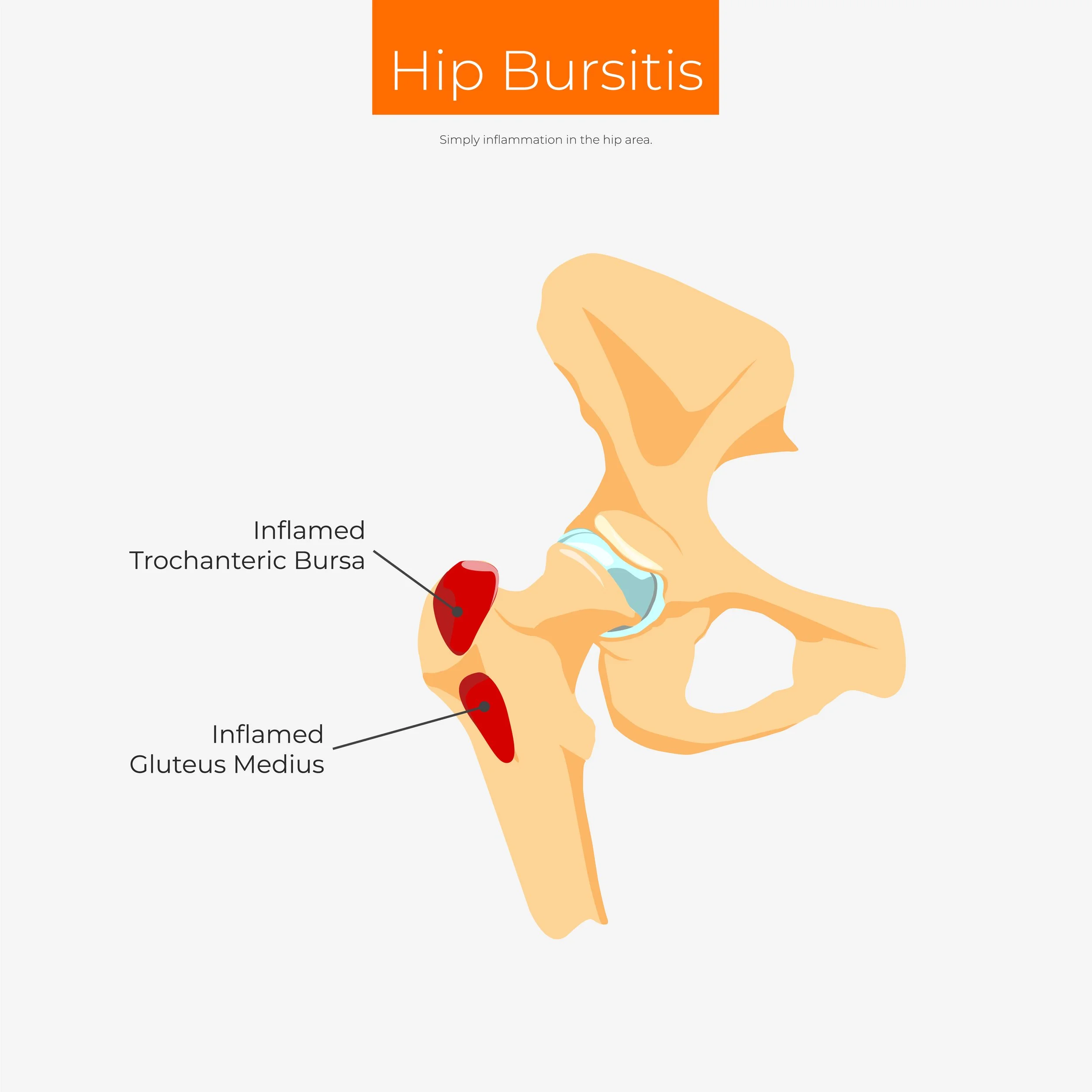Trochanteric Hip Bursitis. Inflammation in the hip area. Anatomy diagram poster inforgraphic