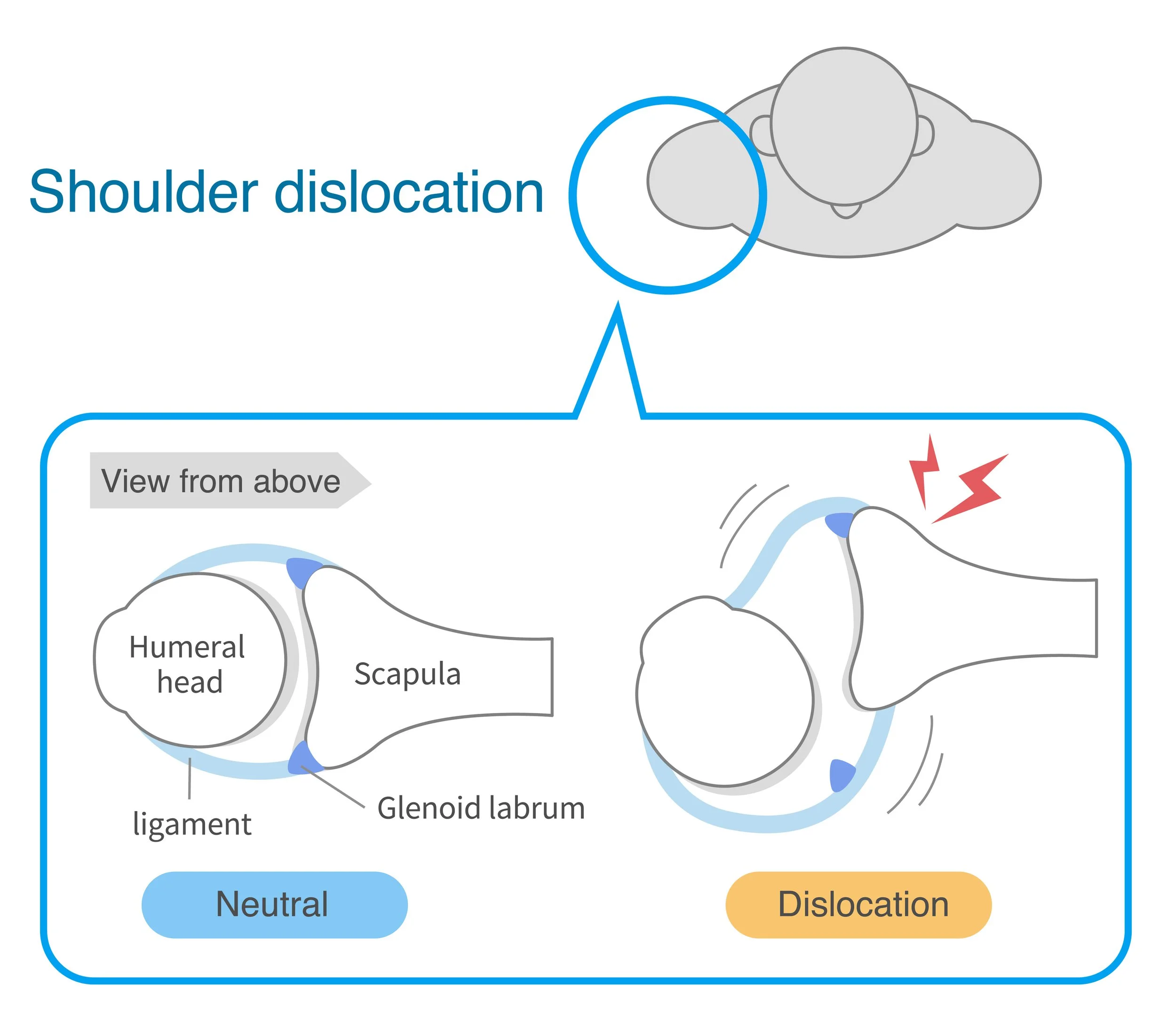 Mechanism and causes of shoulder joint dislocation from above