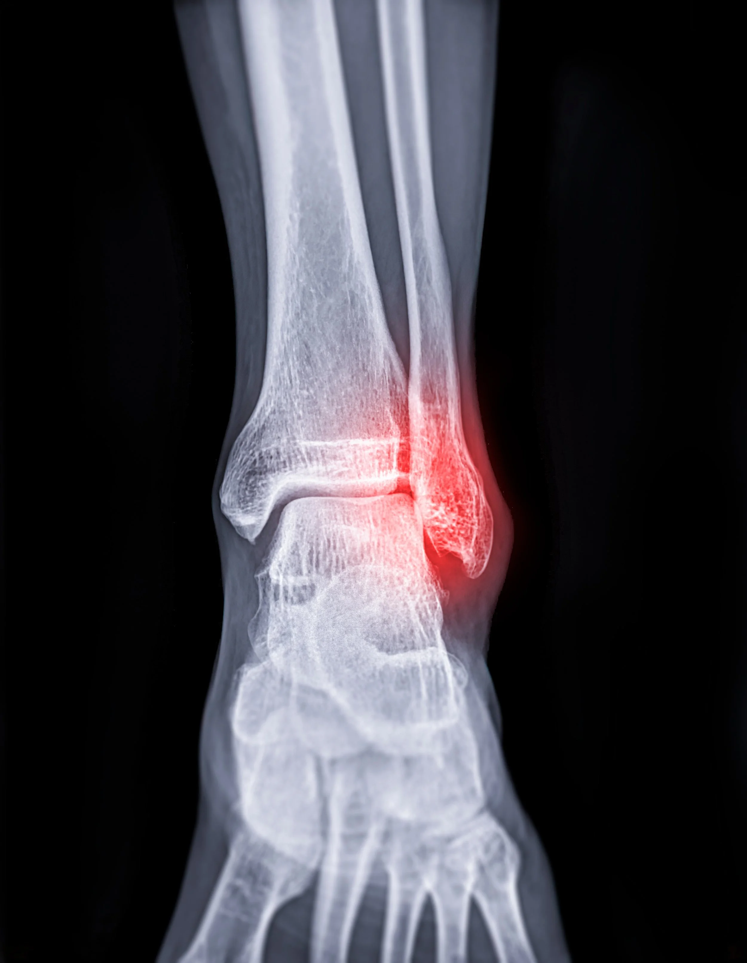 X-ray image of ankle joint showing fracture of ankle joint