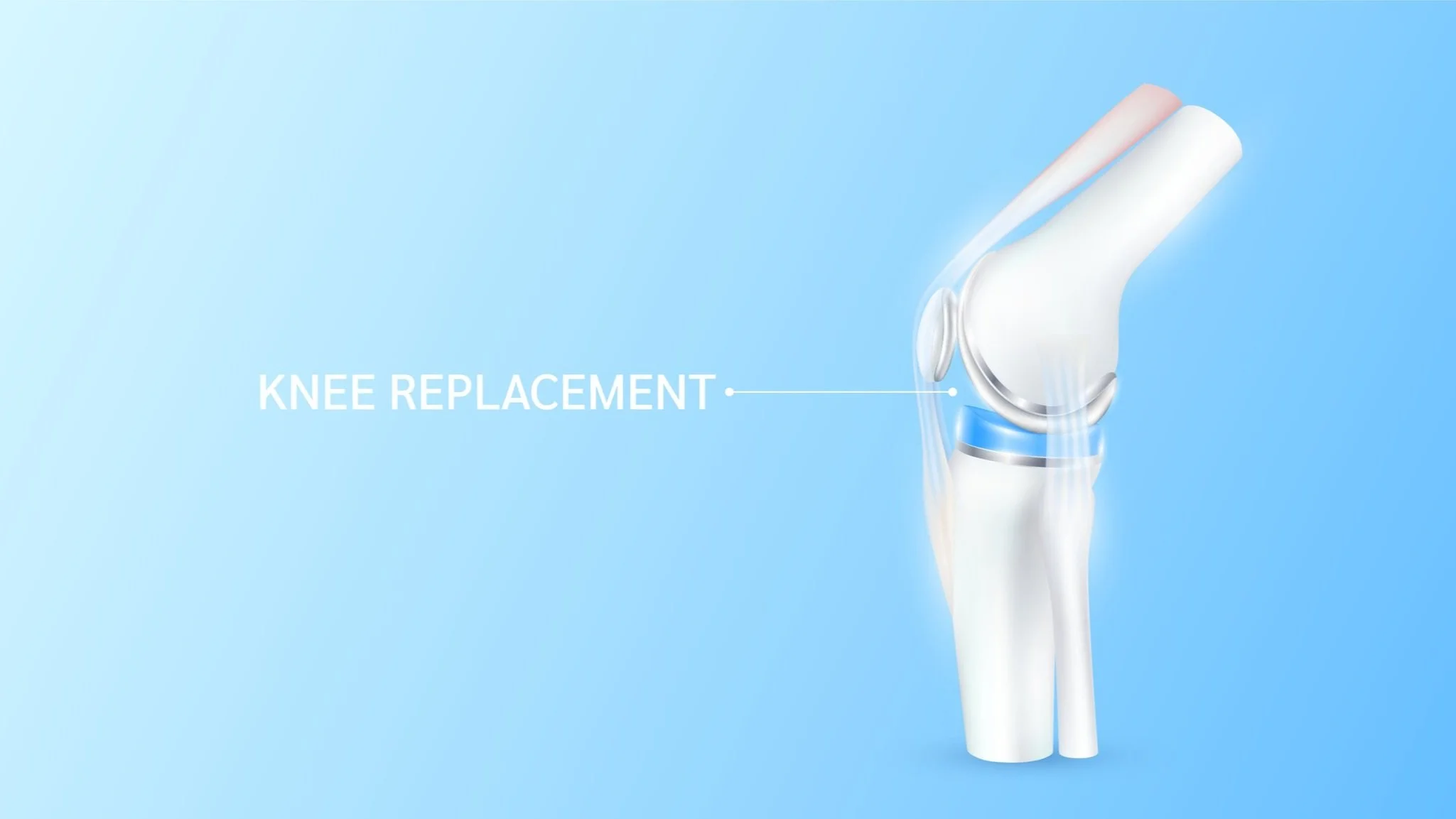 Illustration of knee replacement surgery with prosthetic joint on blue background.