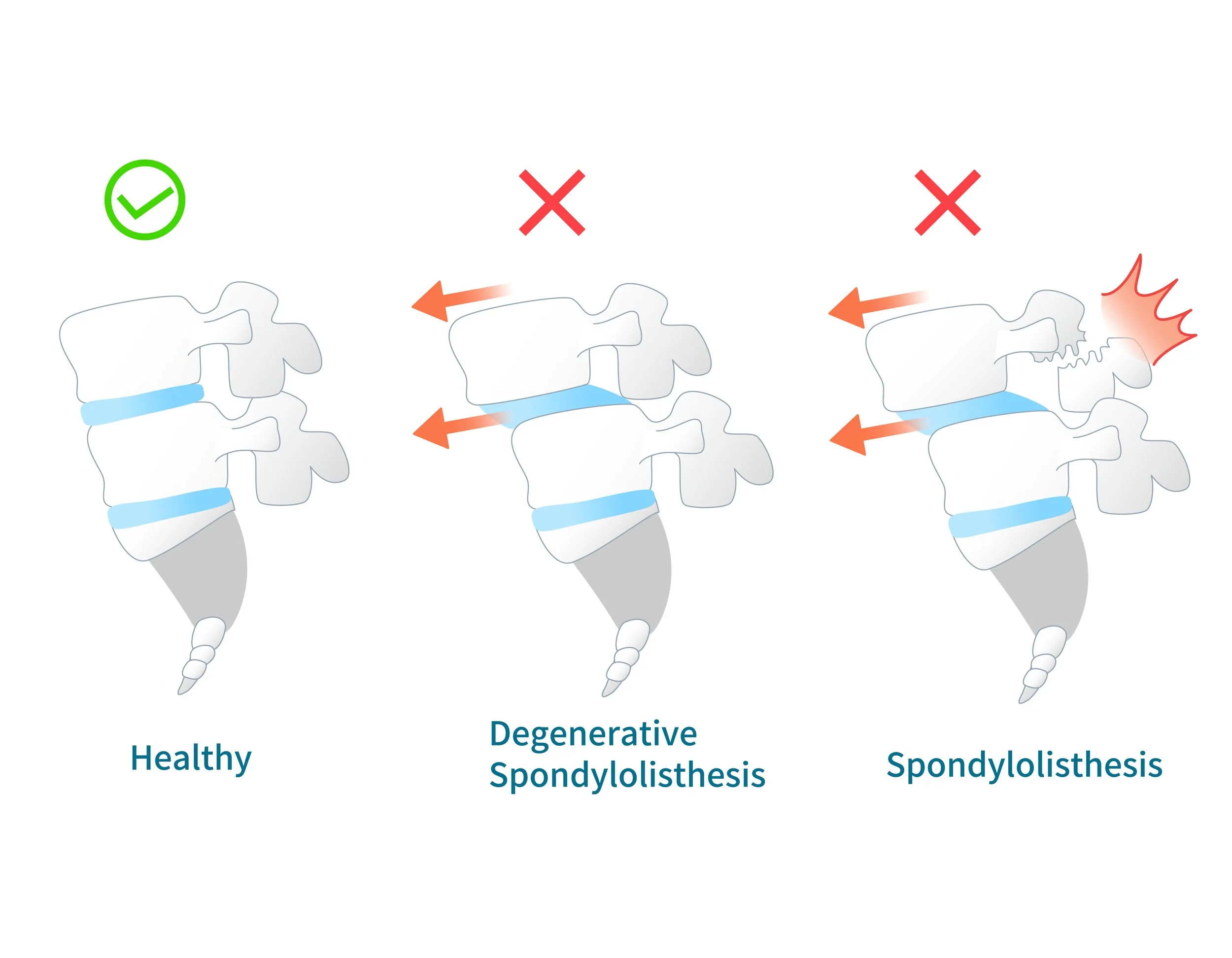 Illustration of the Spondylolisthesis Symptoms