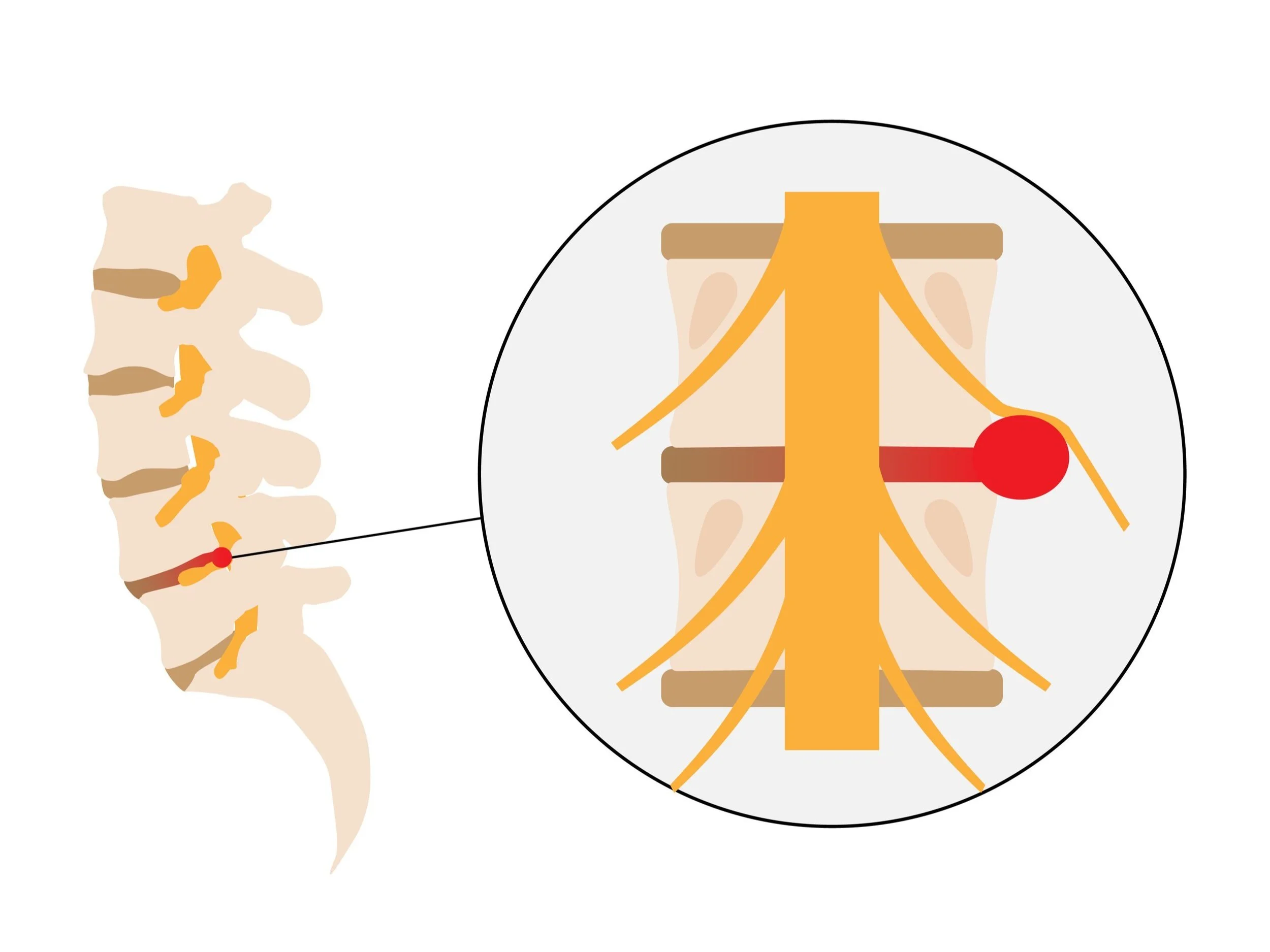 Illustration of a herniated disc in the spine showing disc and nerve detail.