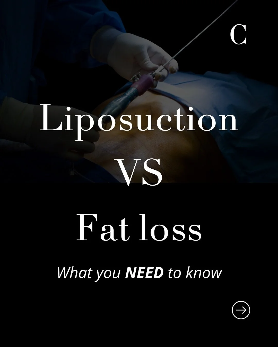 Fat loss VS liposuction &hellip; a common question &amp; misconception&hellip; so let&rsquo;s break it down 👇🏼

Both fat loss and liposuction serve distinct roles in achieving aesthetic outcomes. 

Fat loss, driven by a caloric deficit, exercise, a
