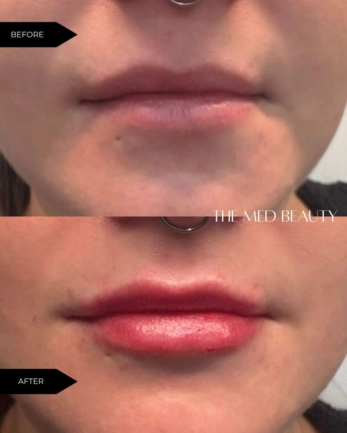 Love these mistletoe ready results! 

This beauty took advantage of our The Med Contour &amp; Smooth Package &amp; received the perfect combo of tox and filler!! 

#injectorcc #somdinjector #botox #juvedermlips #fillerbeforeandafter
