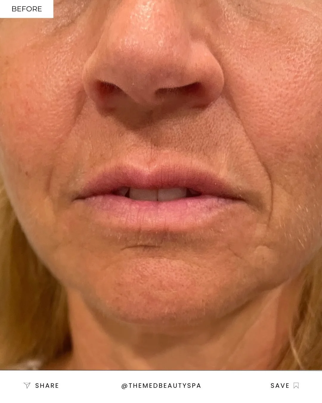 Smile lines tell a story &mdash; we just help soften the chapters ✨

This before &amp; after shows how dermal filler can gently smooth lines around the mouth while preserving natural movement and expression.

Swipe to see her results!