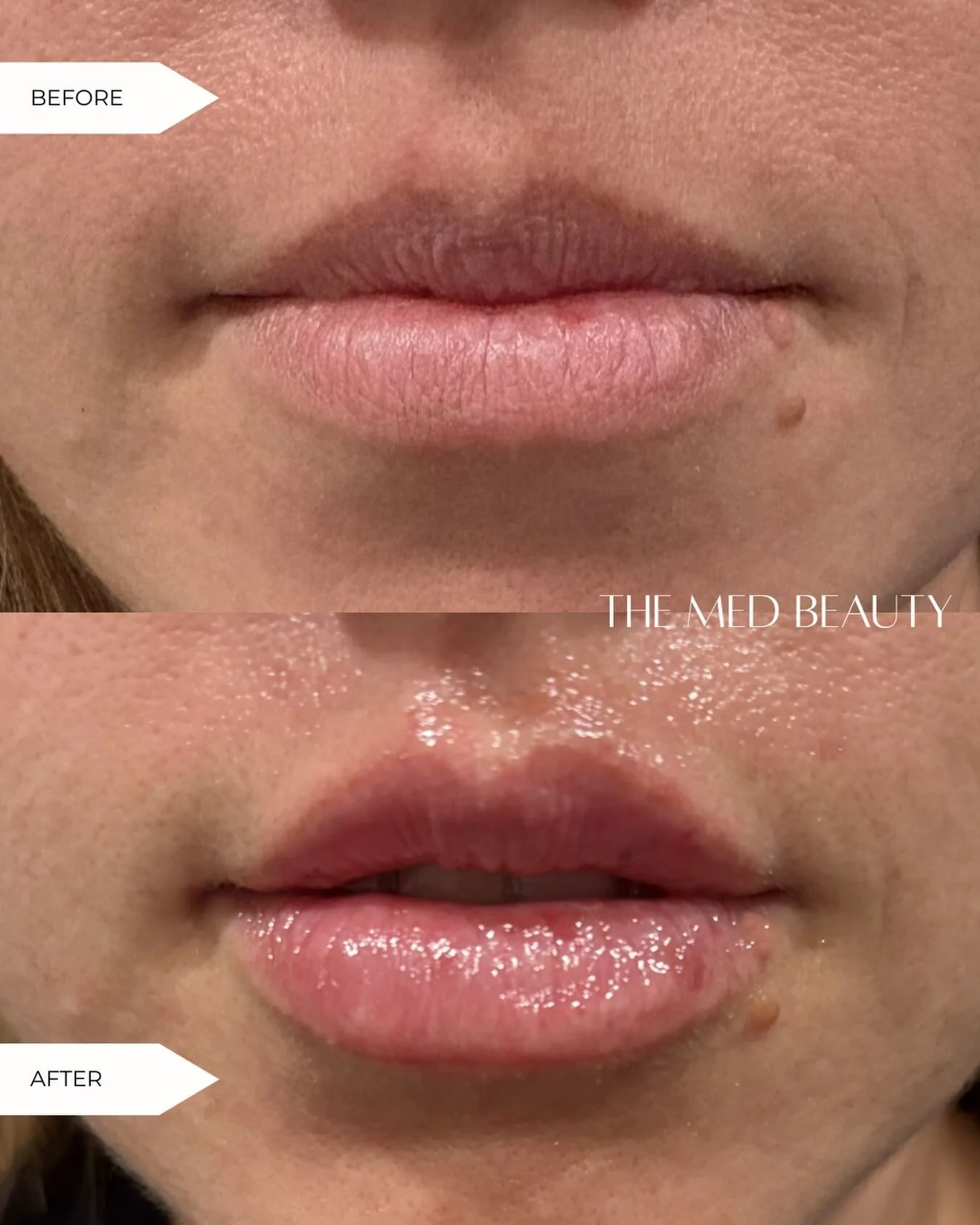 POV: You finally booked the lips 💋

This before &amp; after says it all &mdash; hydrated, defined, and beautifully enhanced without looking overdone.

✨Lip filler special
Was $650
Now $500 (this month only)

Don&rsquo;t wait &mdash; this pricing dis