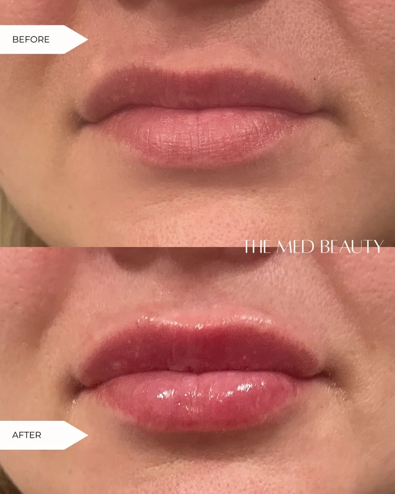 A little balance makes a big difference 💋

Lip filler isn&rsquo;t always about going bigger &mdash; sometimes it&rsquo;s about creating better symmetry and harmony. By subtly enhancing shape and evening out the lips, we can create a naturally balanc