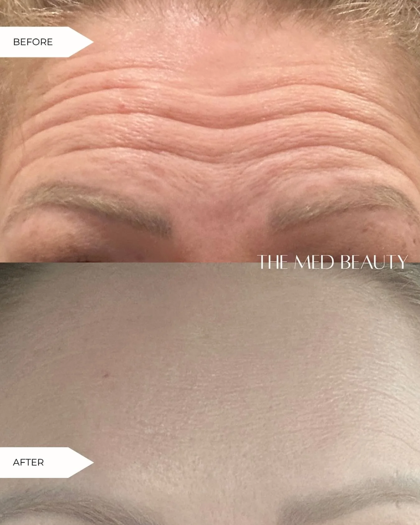 Forehead lines? We don&rsquo;t know her. 

A little sprinkle of Tox and 2 weeks is all it took for these refreshed and natural results✨