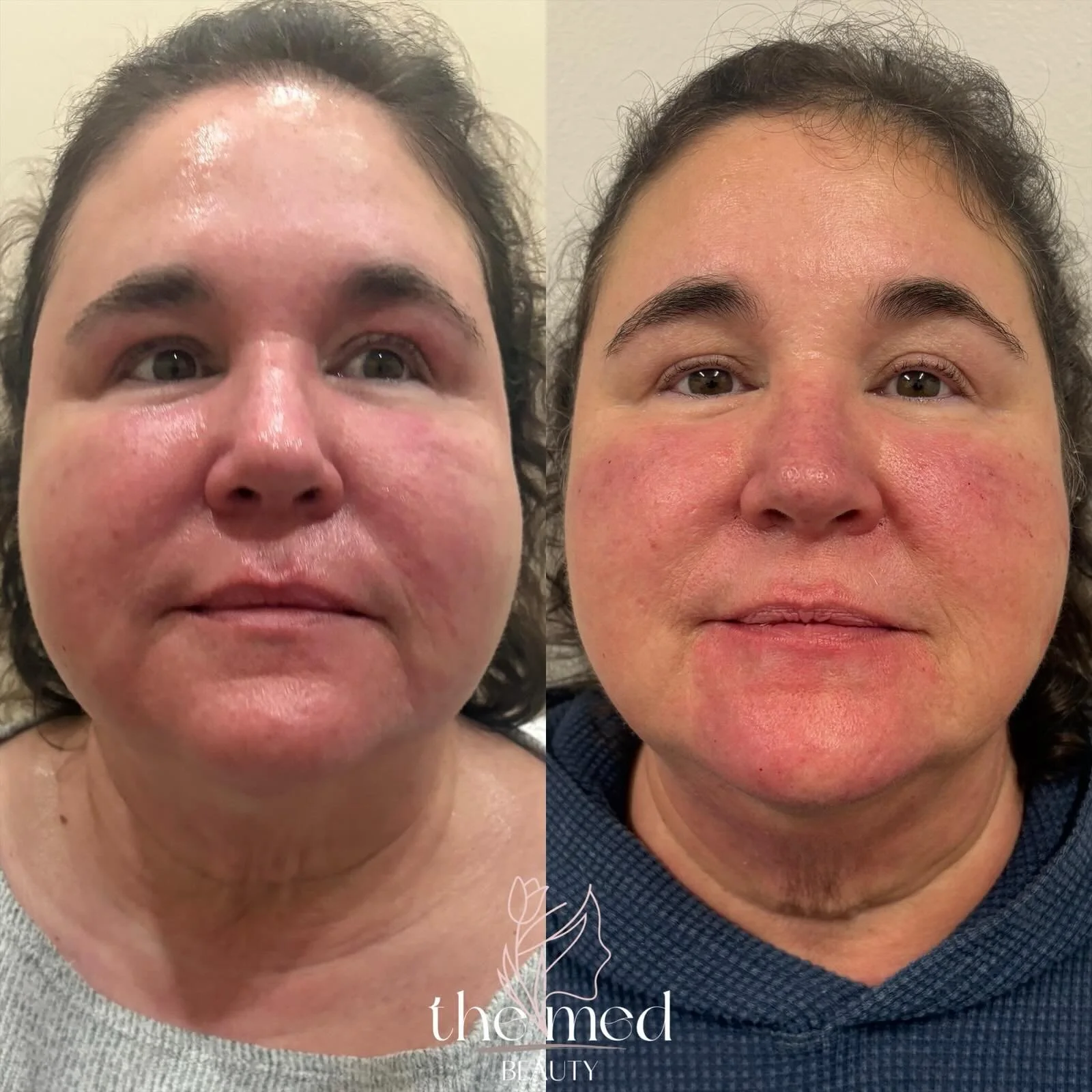 POV: You can&rsquo;t quite put your finger on what&rsquo;s different&hellip; but everything looks more balanced. ✨

This full facial balancing treatment used filler to restore proportion, support facial structure, and enhance natural beauty&mdash;wit