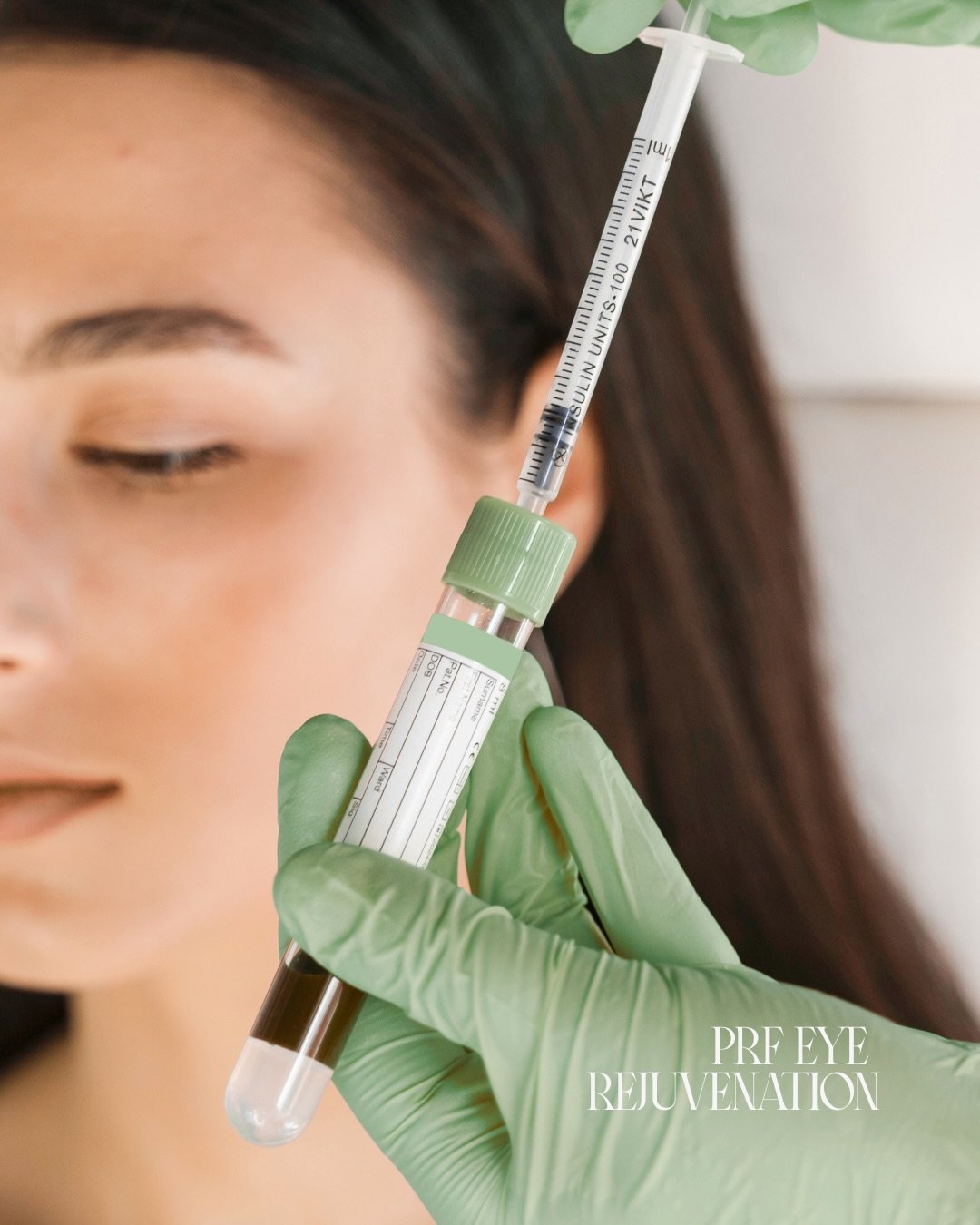Tired under-eyes? This is your sign.👏👇🏻

PRF eye rejuvenation uses your body&rsquo;s own growth factors to smooth, brighten, and refresh &mdash; naturally, no filler look.

Book your PRF treatment with Chelsey Morrow, NP-C at Elev&eacute; and let 