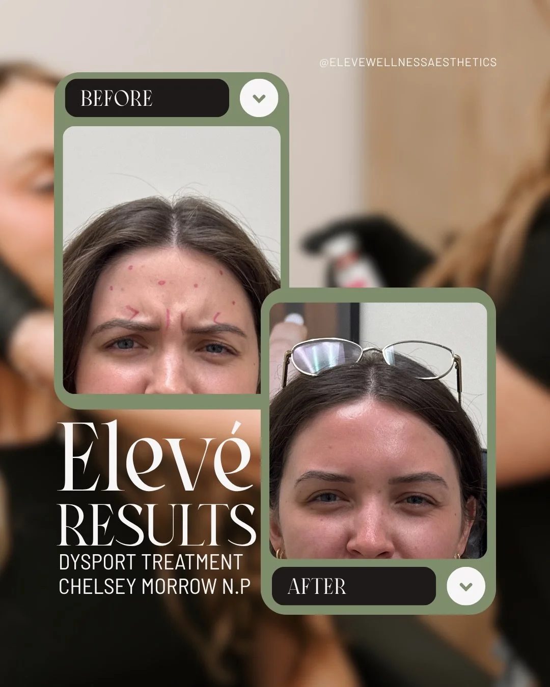 The result of a Dysport treatment? Let&rsquo;s chat.👇🏻

Delivers results that show a smoother, refreshed appearance that still looks like you.

At Elev&eacute; Wellness &amp; Aesthetics, we don&rsquo;t believe in freezing faces. We believe in preci