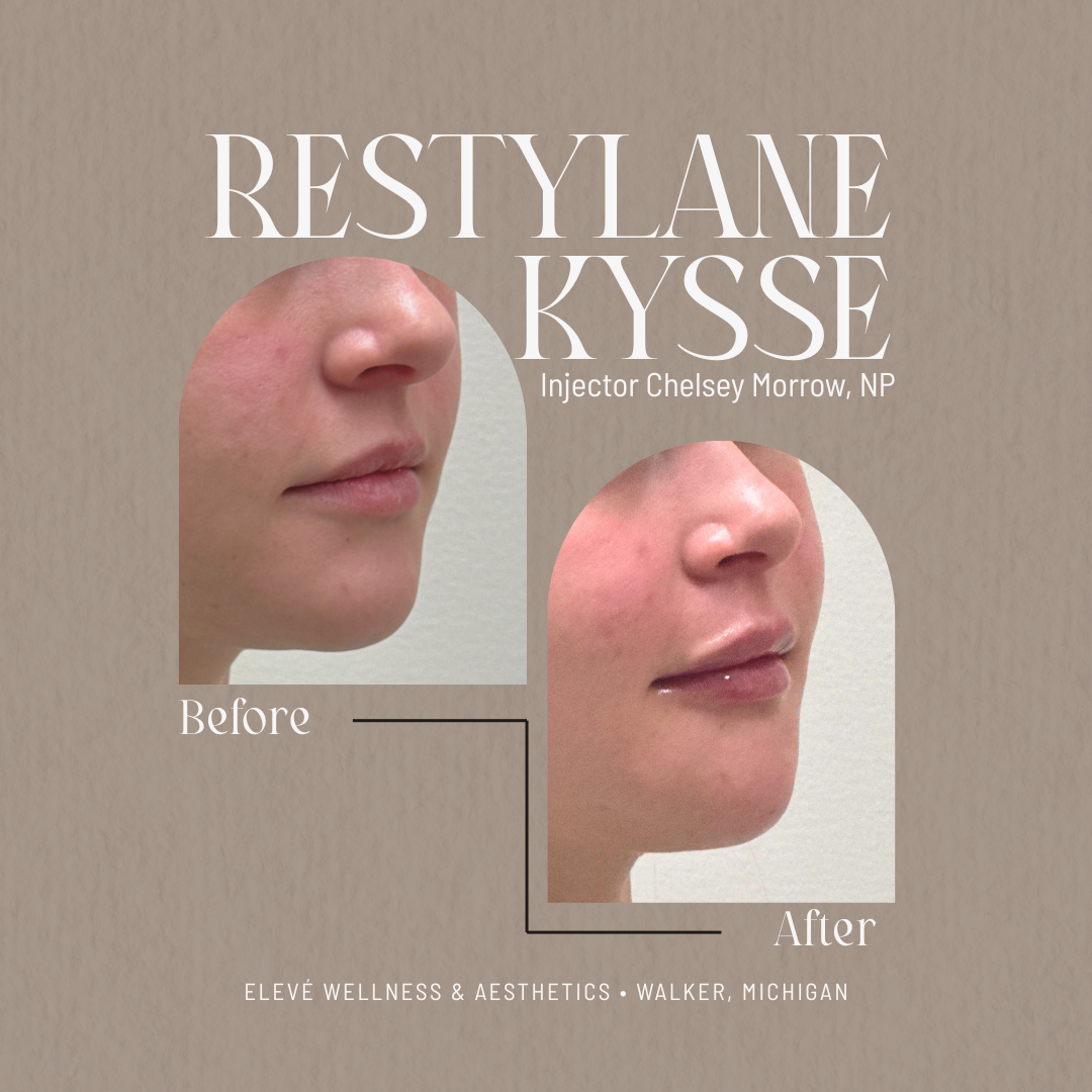 before and after Elevé (1080 x 1080 px).png