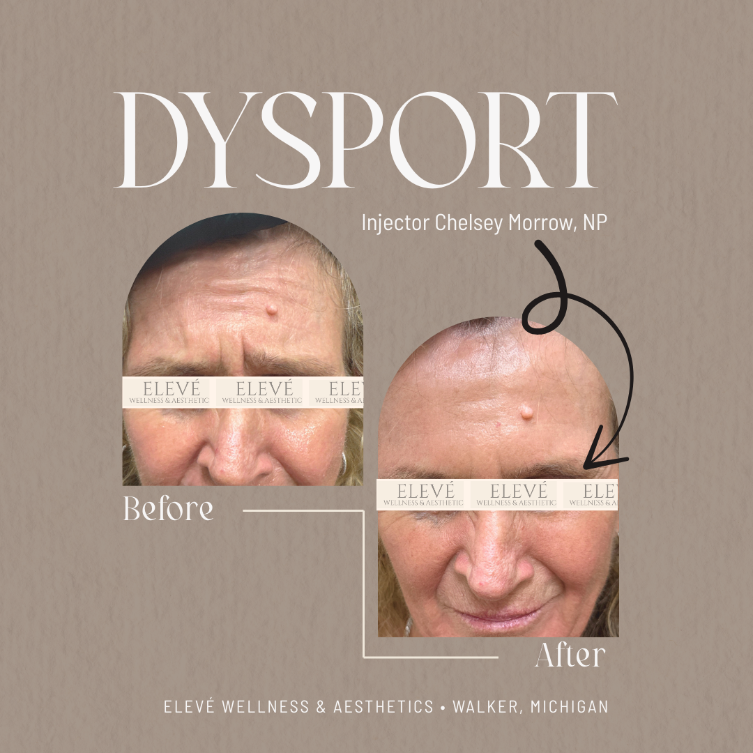 before and after Elevé (1080 x 1080 px) (2).png