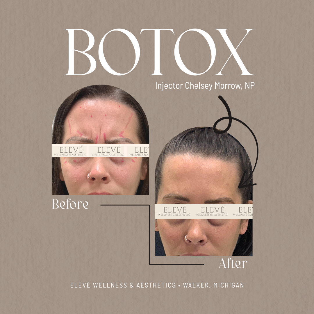 before and after Elevé (1080 x 1080 px) (3).png