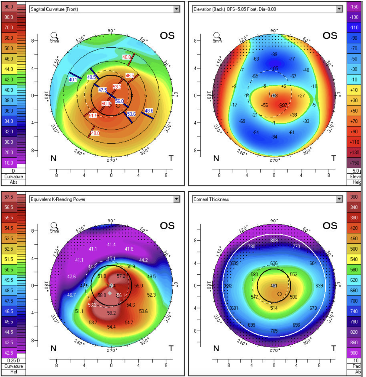 tomografia topografia cornea