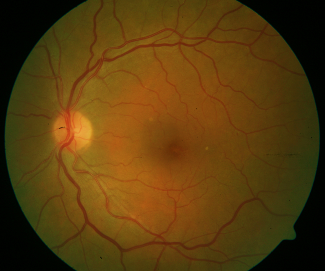 Retina Normal