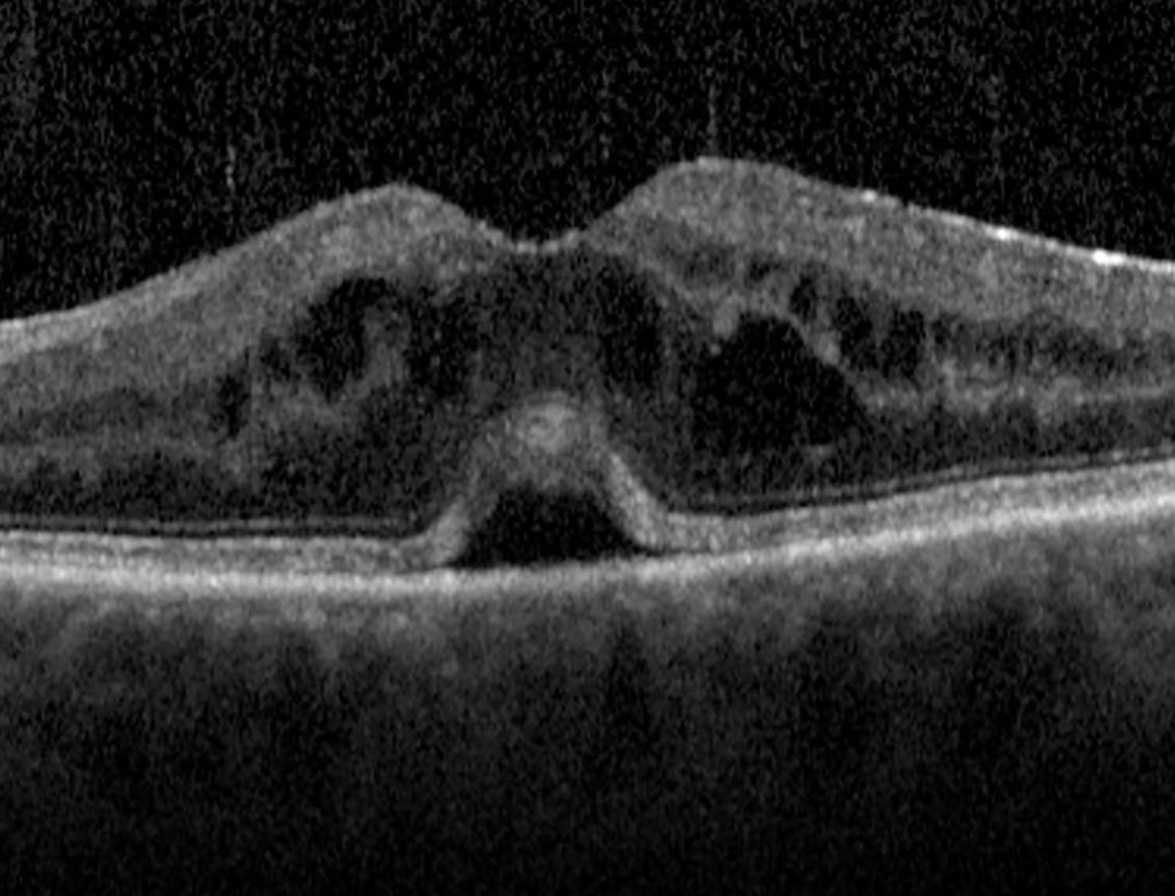 Edema macular na diabetes