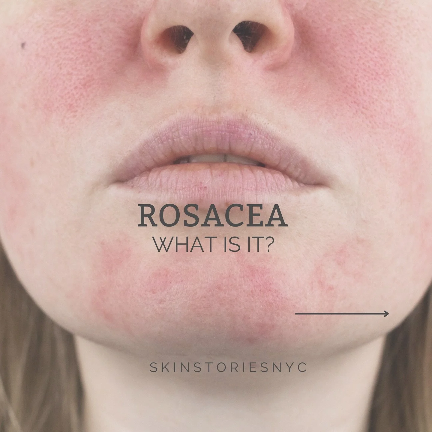 🍃It can also cause the dilation of capillaries (telangiectasias) and a burning sensation in the skin

🍃There is no cure for rosacea, but treatment can help control symptoms 

🍃Common treatments include: Laser therapy and chemical peels.