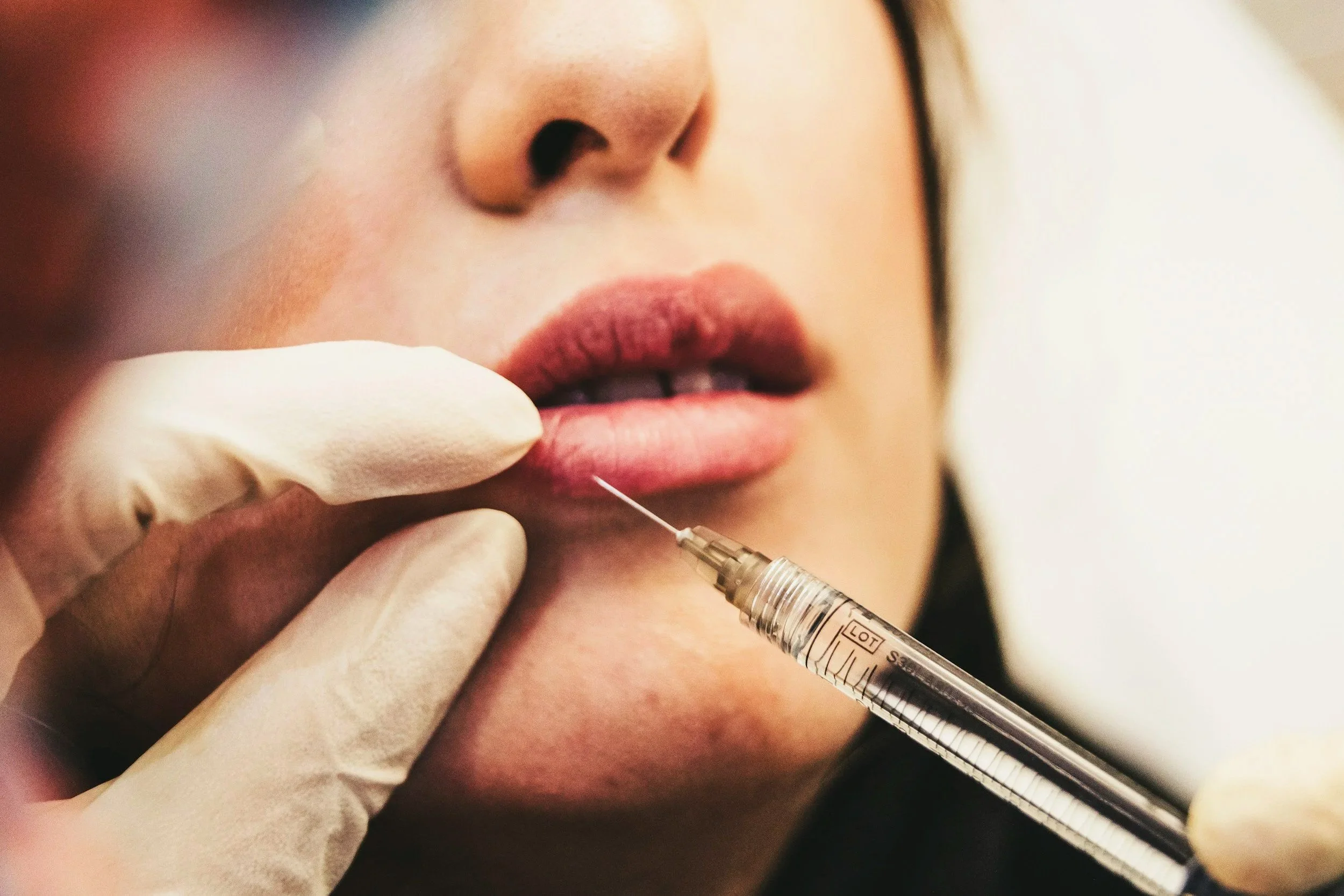 A person receiving a cosmetic injection near their lips, with a healthcare professional holding a syringe and wearing gloves.