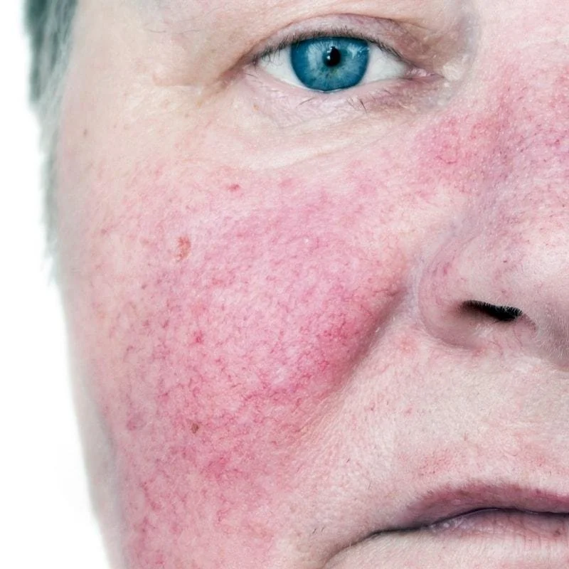 How Ethos Treats Rosacea: A Science-First, Inside-Out approach. Because treating the skin alone isn’t enough.