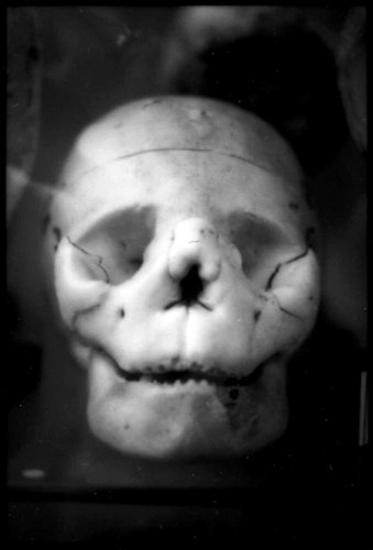 Hyperostosis - Excessive bone growth of the the skull