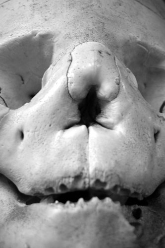 Hyperostosis