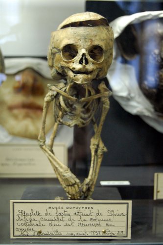 Spina bifida