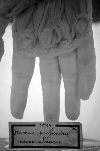 Ramus profundus nervi ulnaris - Dissected hand displaying muscles and nerves of the palm