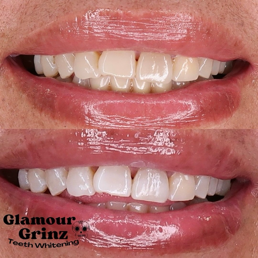 Before &amp; After - 2nd Whitening Session 😮&zwj;💨🦷

Book Now‼️
Link in Bio | or Thru DM

~ Glamourgrinz.com

📍 Green Bay, WI

#whiteteeth #greenbaywi #teethwhitening #wisconsin #smallbusiness #beforeandafter #smile #whitening #glowup