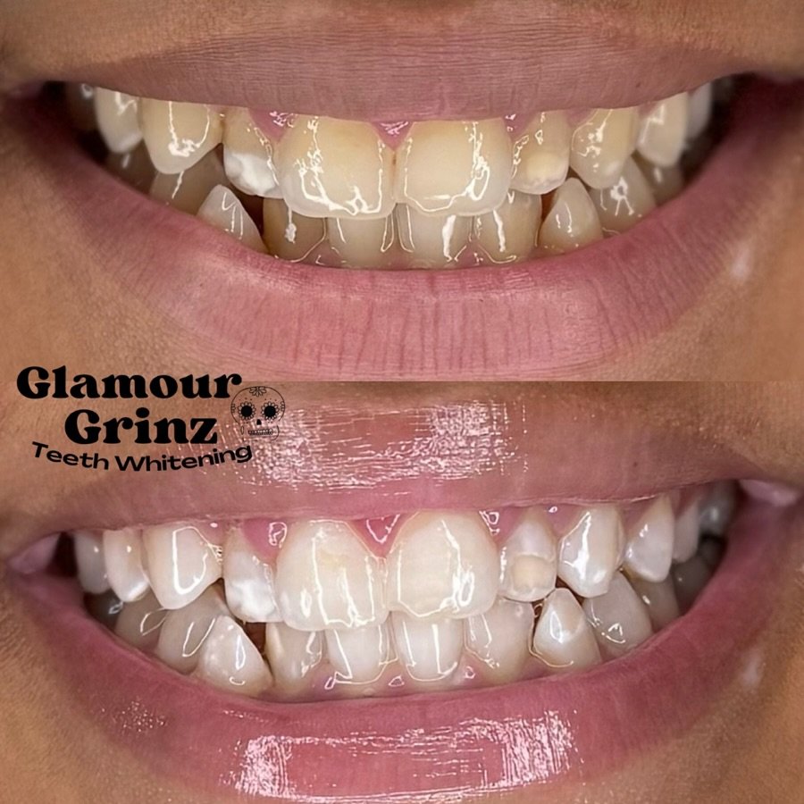 Did you know ⁉️ You don&rsquo;t always notice your teeth are dull &mdash; until you start Whitening with us and fall in LOVE with your results! 🫶🏼🦷

Interested in your first session?
↪️ Click Link in Bio | or Thru DM 📩

~ Glamourgrinz.com ~

#bef