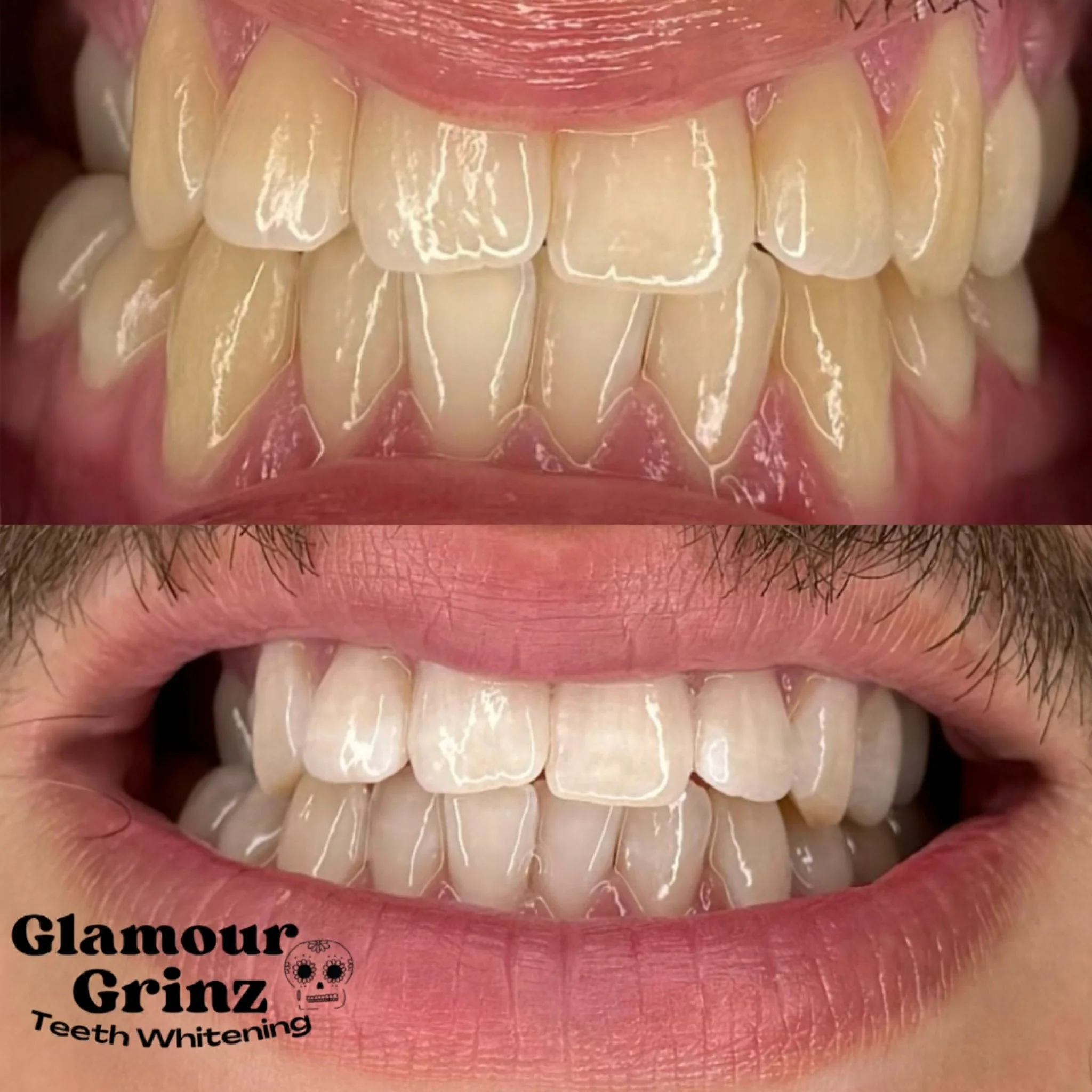 Easy transformation after One Whitening session 🦷

Book Now! 😁

#glamourgrinz #teethwhitening #smiletransformation #beforeandafter #greenbaywi #wisconsinwhitening #greenbay #booknow