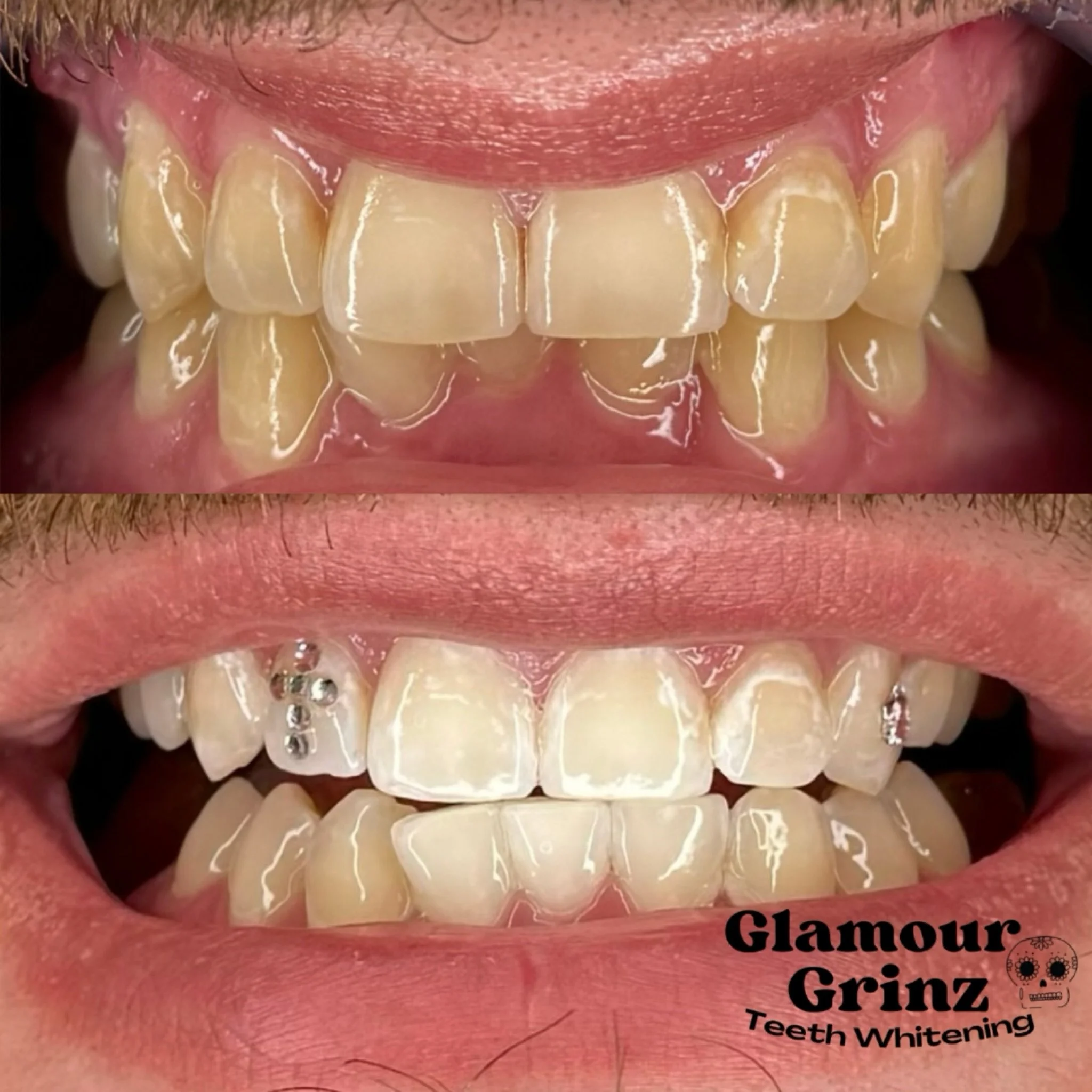 From just ONE whitening session! 🤩🦷
They&rsquo;re going to look unrecognizable after his 2nd session!! 👏

Click &ldquo;Book Now&rdquo; in bio to lock in your appt. ✅📅

#glamourgrinz #wisconsin #discovergb #greenbayteethwhitening #toothgems #white