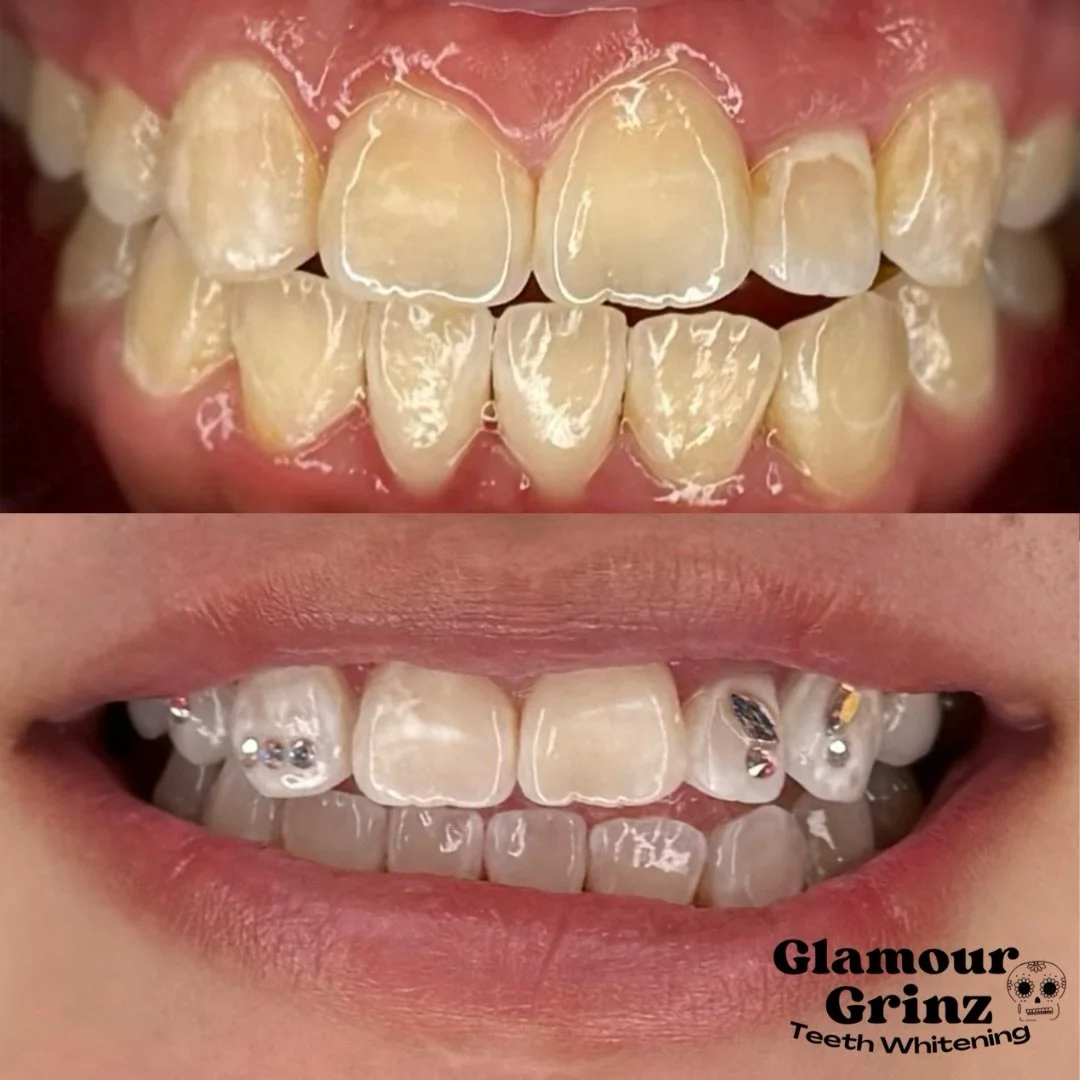 before &amp; after whitening 🦷✨
results you can see instantly 😁🩵

appointments filling &mdash; book yours now ⏳

🌐 link in bio
📞 (920) 412-4965
📍 Green Bay, WI

#greenbay #wisconsin #teethwhitening #toothgems