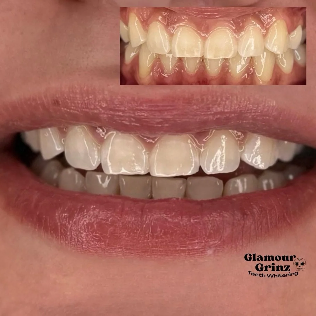 Between coffee, wine, and daily habits, staining happens.
A whitening session is an easy way to freshen up your smile 🦷✨

Green Bay teeth whitening 😃

Link in bio 🩵

#glamourgrinz #greenbaywi #teethwhitening